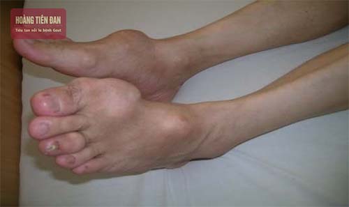 Bệnh gout trẻ hóa gây ra nhiều biến chứng nghiêm trọng