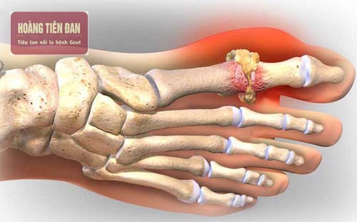 Bệnh gout phát triển qua 3 giai đoạn chính từ nhẹ cho đến nặng.
