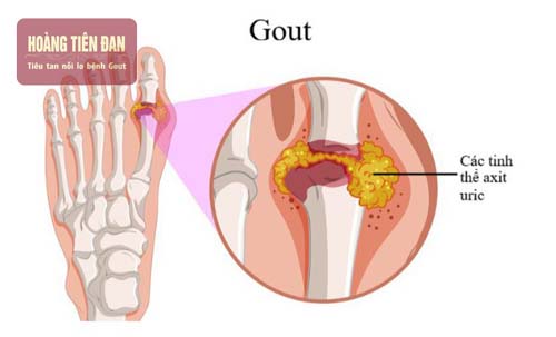 Người bị gout thường có hàm lượng acid uric trong máu cao.