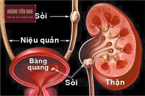   Sỏi có thể hình thành ở thận, niệu quản hay ngay tại bàng quang.