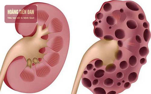 Suy thận khiến các chức năng của thận bị suy giảm.