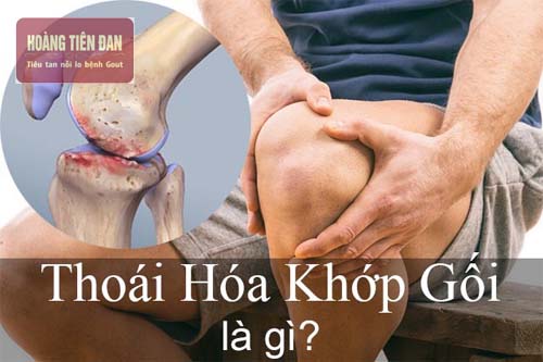   Thoái hóa khớp gối.