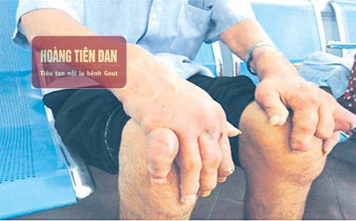   Bệnh gout mãn tính kéo dài có thể gây tàn phế, đột quỵ.