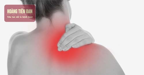   Gout cũng là một trong những nguyên nhân dẫn đến đau vai.