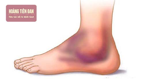 Viêm khớp mắt cá chân