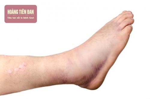  Tràn dịch khớp cổ chân gây sưng đau và thậm chí còn bị bầm tím.