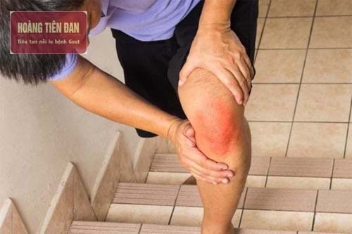  Tràn dịch khớp gối gây đau đớn và khó khăn khi di chuyển.