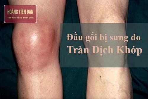  Tràn dịch khớp gối gây sưng phù và đau nhức.