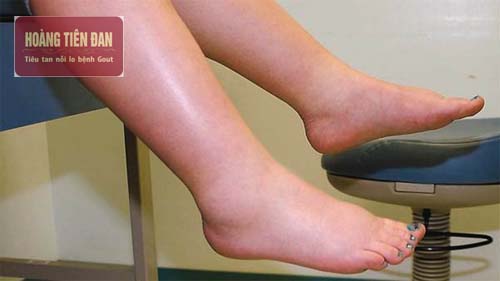   Ứ đọng dịch gây sưng phù chân do suy thận độ 4