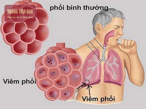   Uống nhiều rượu có thể dẫn đến viêm phổi