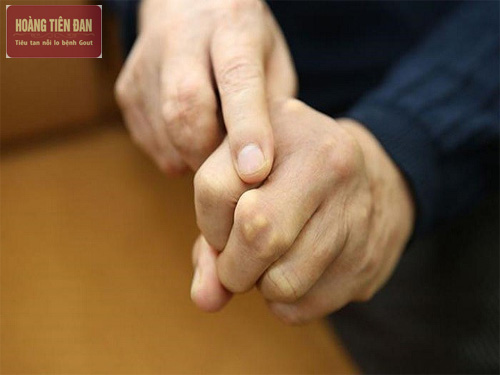 Hạt tophi ở những bệnh nhân bị gout giai đoạn mạn tính