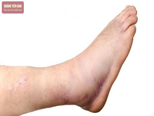 Bệnh gút mắt cá chân khiến người bệnh khó khăn trong vận động