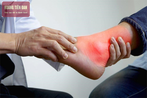 Dùng một số mẹo nhỏ để giảm đau mắt cá chân