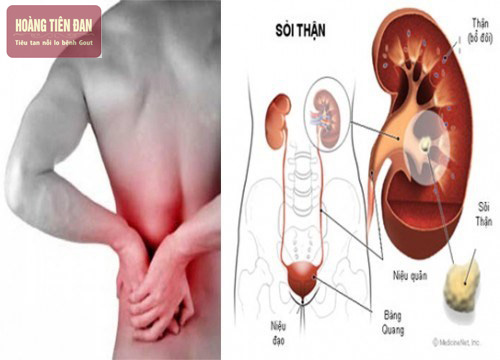 Viêm đài bể thận có thể gây nhiều biến chứng nguy hiểm nếu không được điều trị