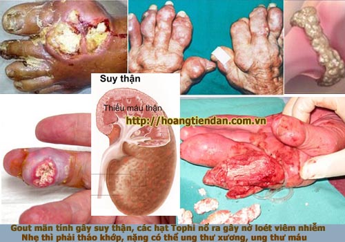 Bệnh gout mãn tính và những biến chứng kinh hoàng