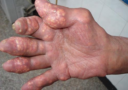 Lời khuyên cho người mắc bệnh Gout mạn tính