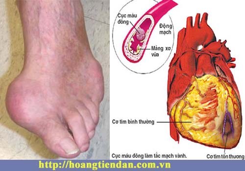 Bệnh gout – “Thủ phạm” làm gia tăng các bệnh lý tim mạch
