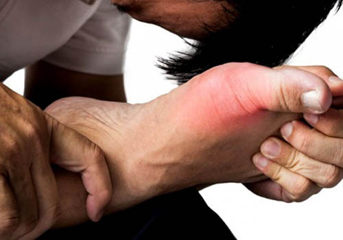Biểu hiện của bệnh gout và bí quyết điều trị hiệu quả