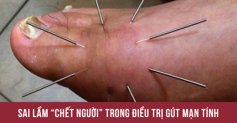 Sai lầm “chết người” trong điều trị gút mạn tính