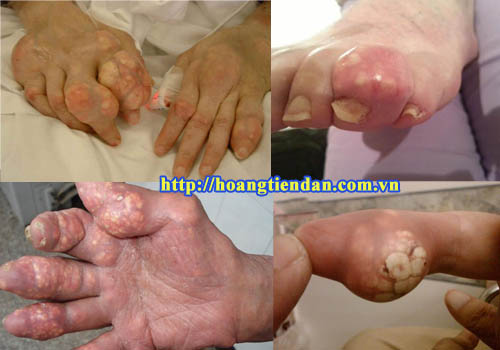 Hạt tophi – “Hung thủ” gây biến chứng bệnh gout nguy hiểm