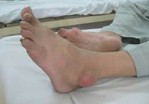 Những biểu hiện của bệnh gout là như thế nào?