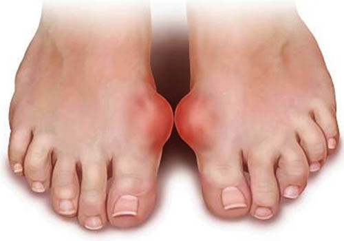 Triệu chứng và cách điều trị bệnh gout hiệu quả nhất