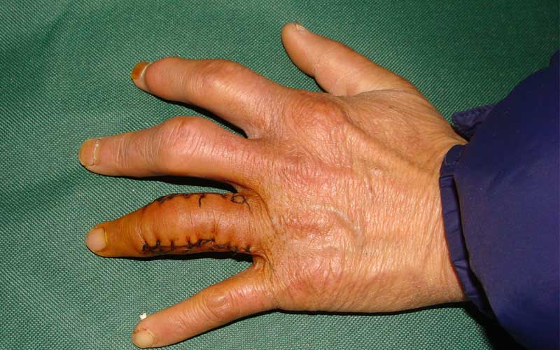 Cây Tơm Trơng: Thảo dược xóa bỏ “lời nguyền” về gút mạn tính