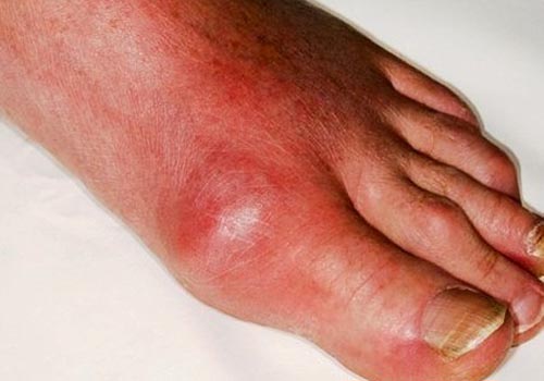 Xử trí như thế nào với bệnh gout cấp tính?